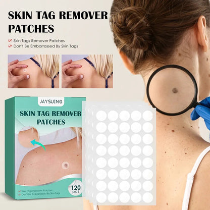 Acne Wart Remover Pimple