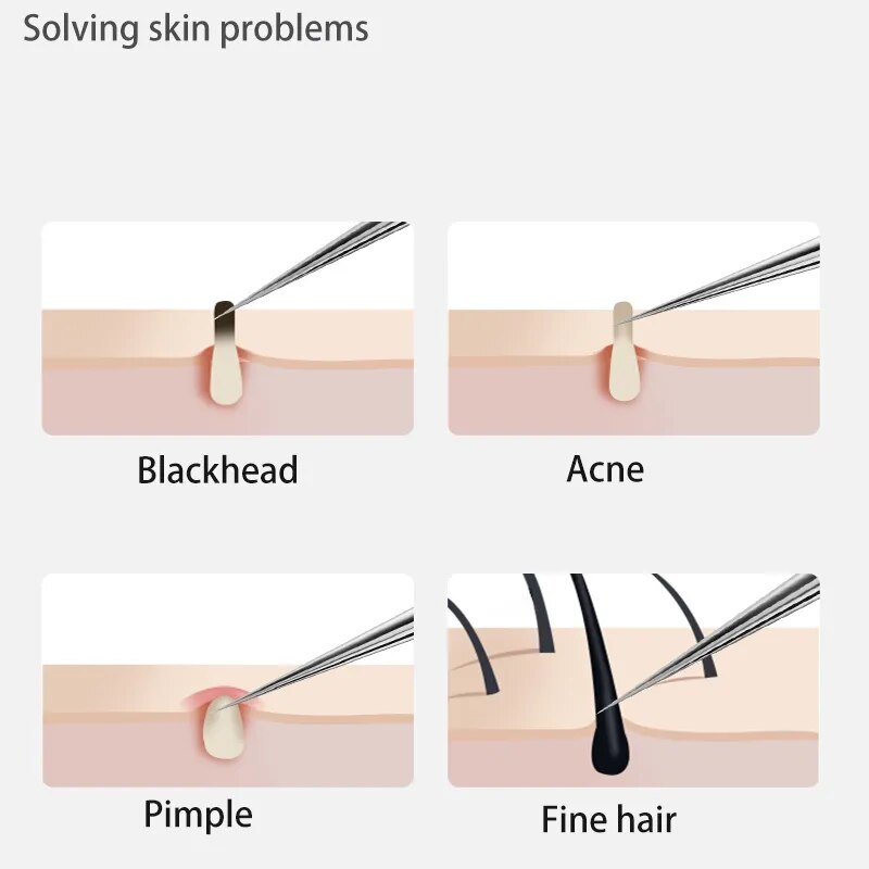 Acne Blackhead Removal Needles